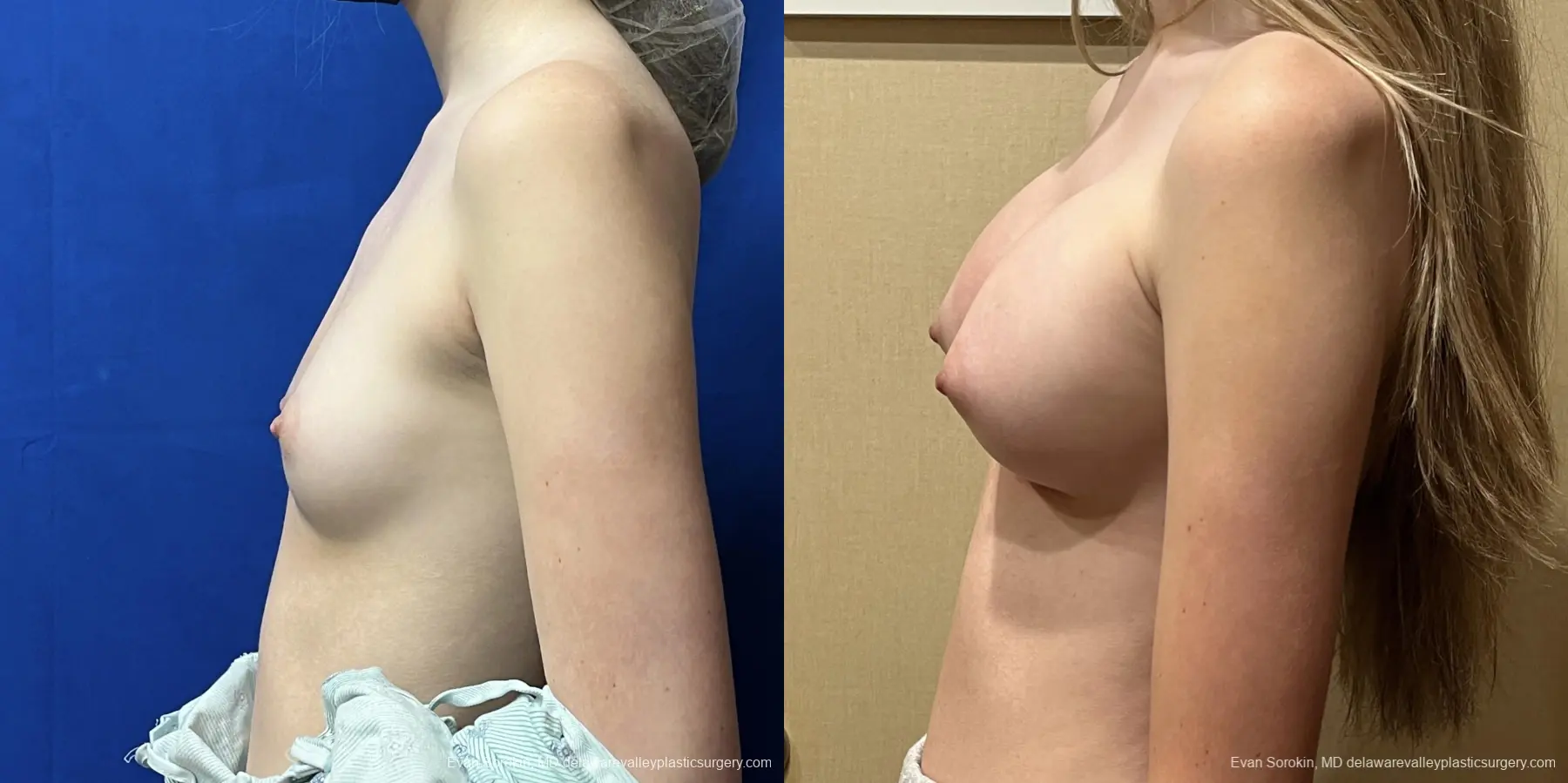 Breast Augmentation: Patient 214 - Before and After 5