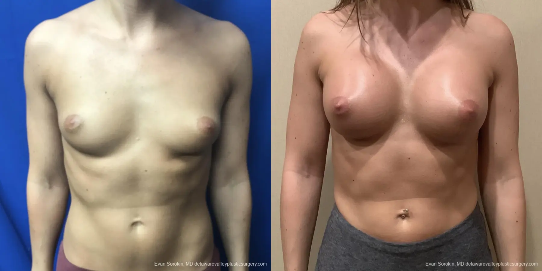 Breast Augmentation: Patient 186 - Before and After 1