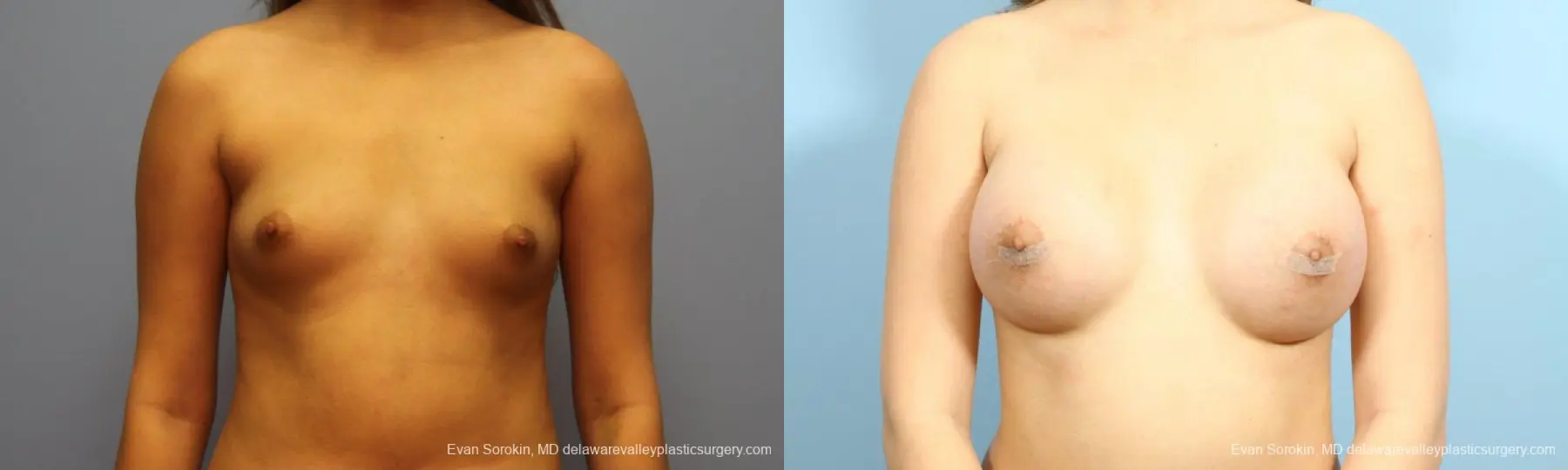 Philadelphia Breast Augmentation 9194 - Before and After 1