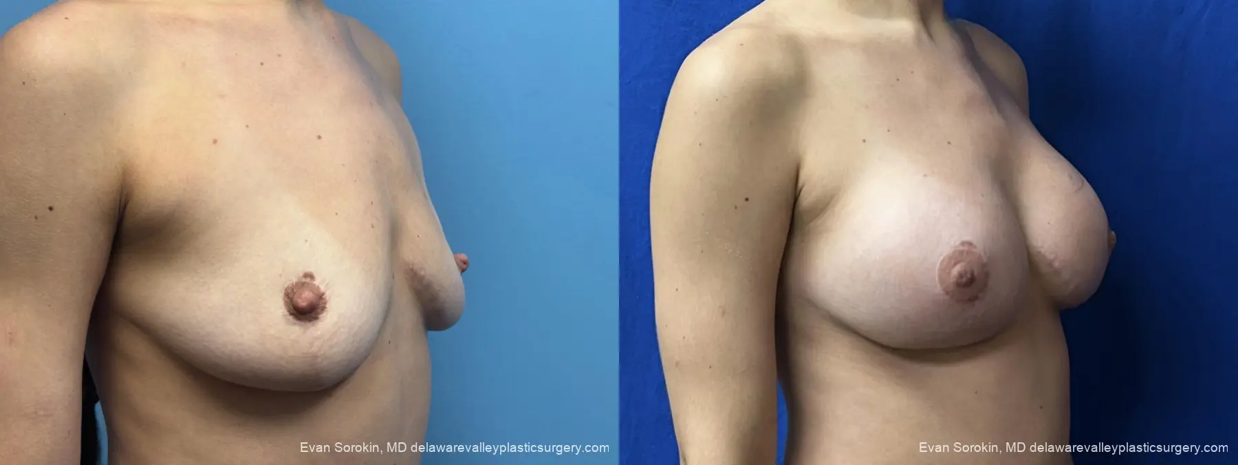 Breast Augmentation: Patient 310 - Before and After 2