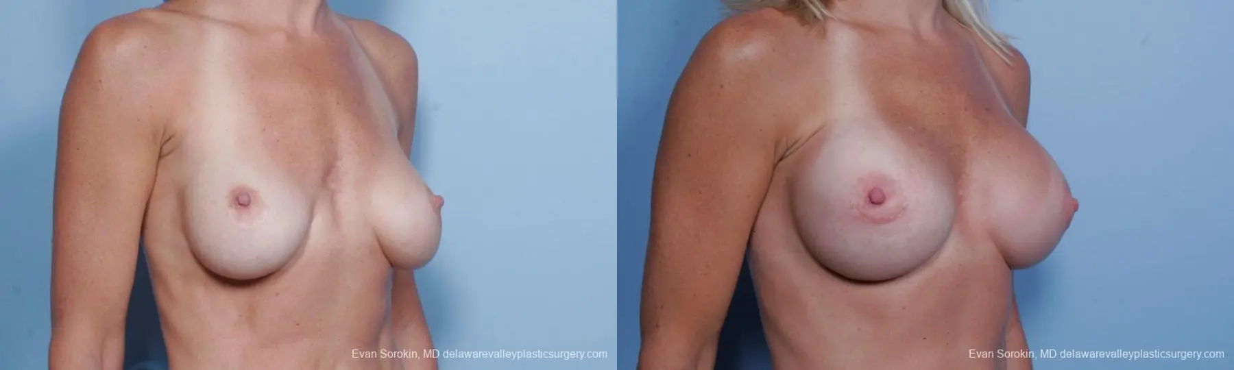 Philadelphia Breast Augmentation 9454 - Before and After 2