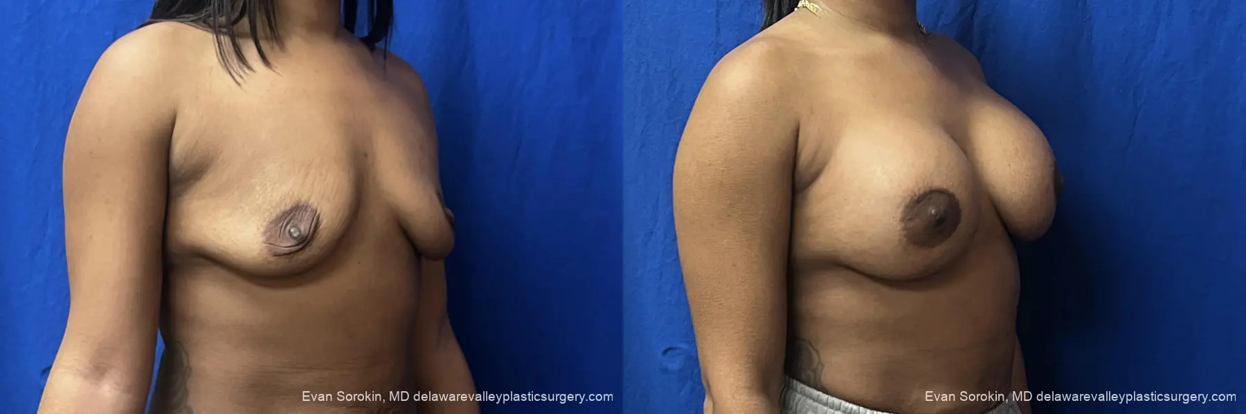 Breast Augmentation: Patient 271 - Before and After 2