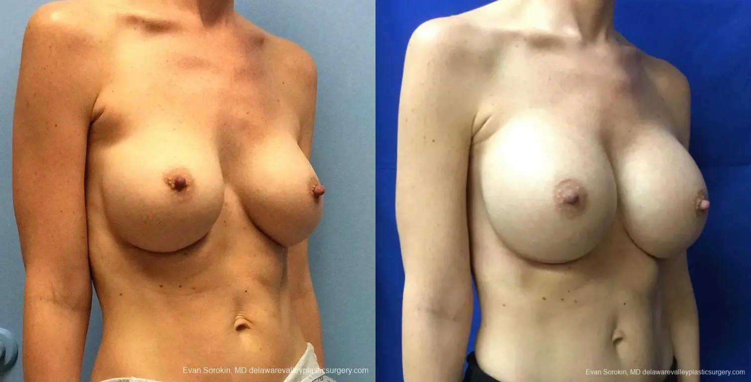 Philadelphia Breast Augmentation 13069 - Before and After 2