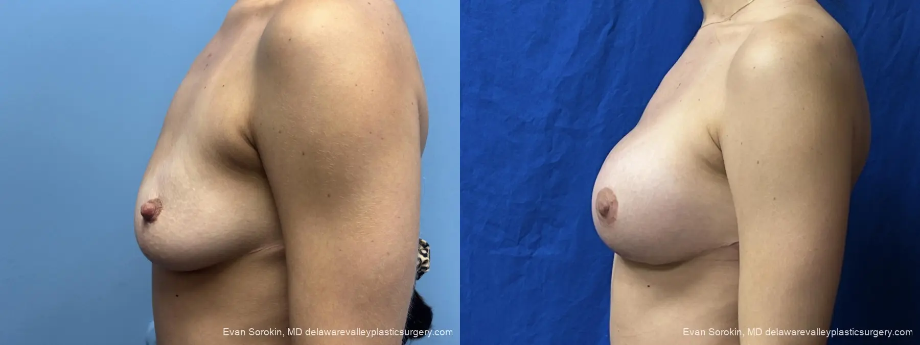 Breast Augmentation: Patient 310 - Before and After 5