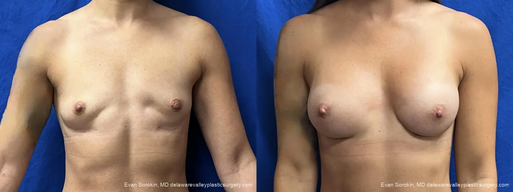Breast Augmentation: Patient 309 - Before and After 1