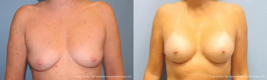 Philadelphia Breast Augmentation 9600 - Before and After 1