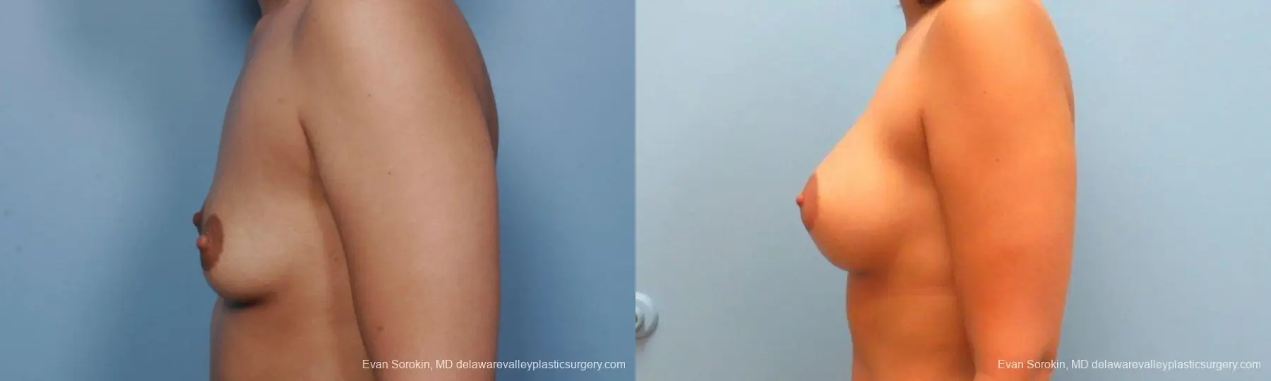 Philadelphia Breast Augmentation 9382 - Before and After 3