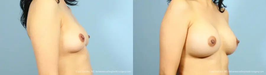 Philadelphia Breast Augmentation 9287 - Before and After 2