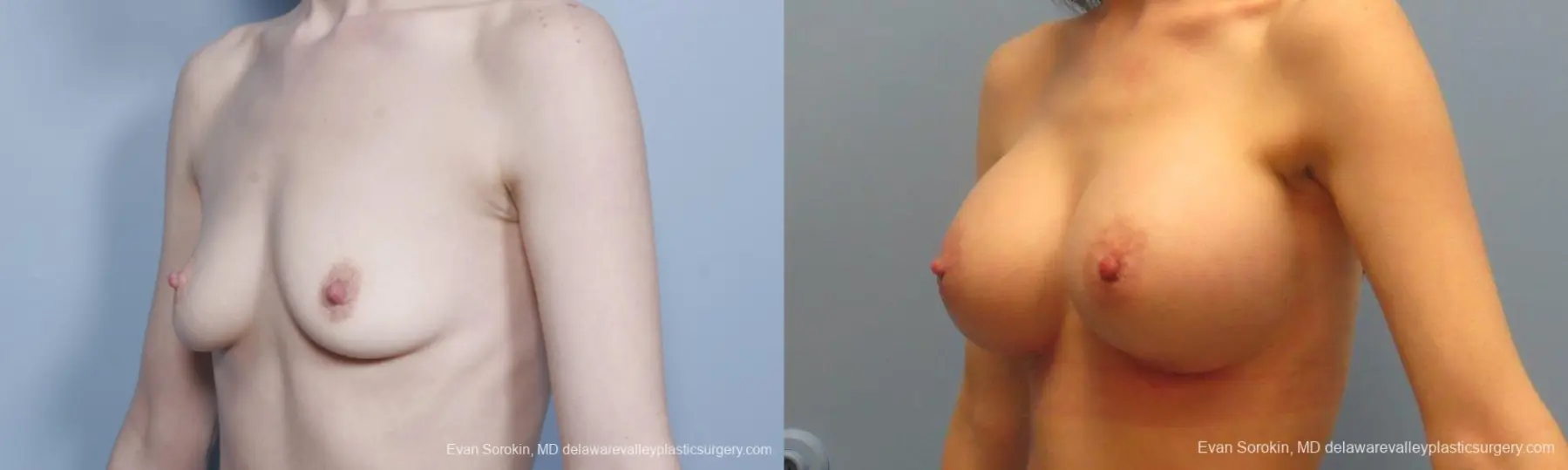 Philadelphia Breast Augmentation 8781 - Before and After 3