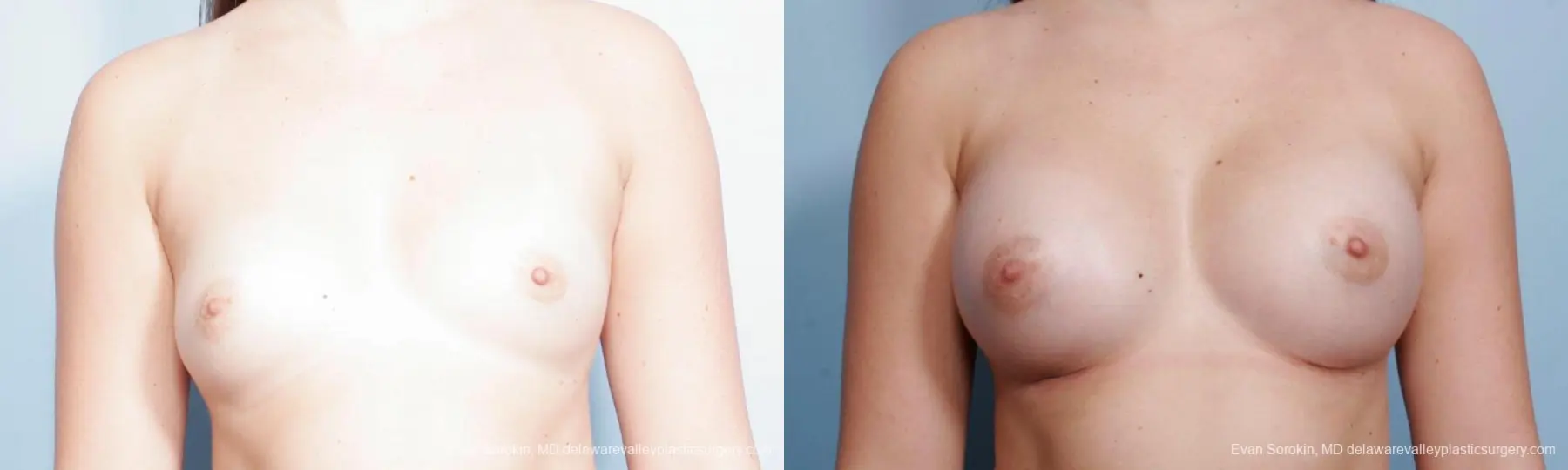 Philadelphia Breast Augmentation 9357 - Before and After 1