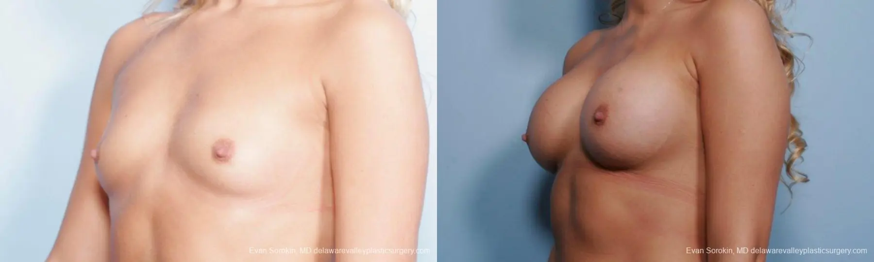 Philadelphia Breast Augmentation 9356 - Before and After 4