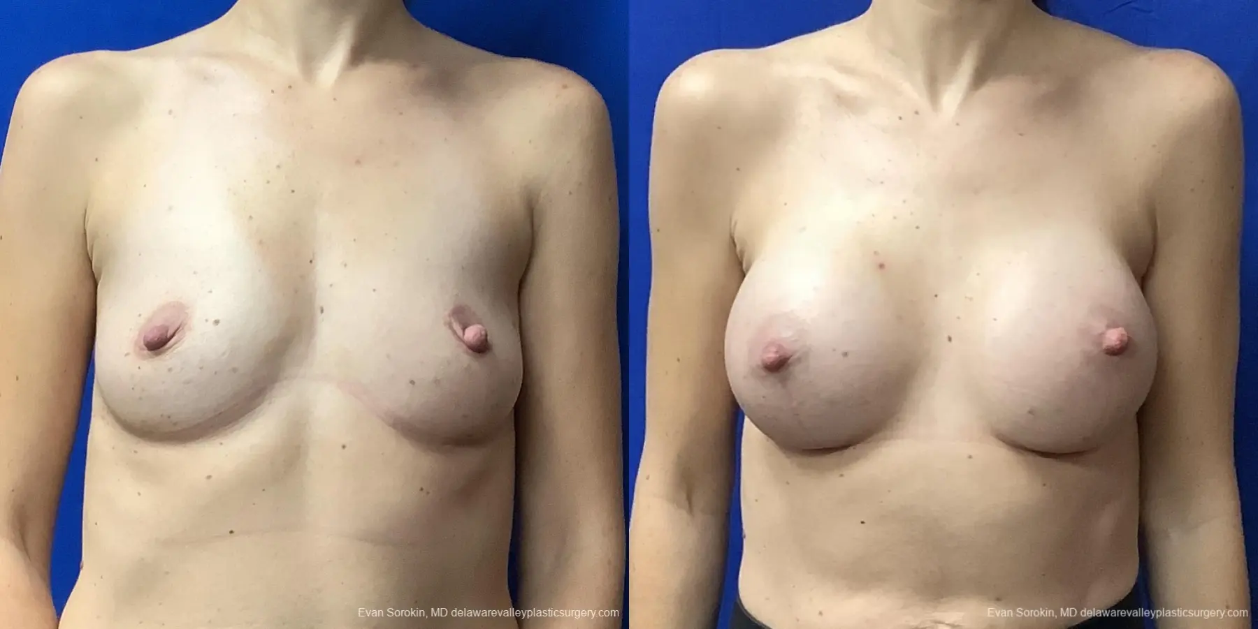 Breast Augmentation: Patient 222 - Before and After 1