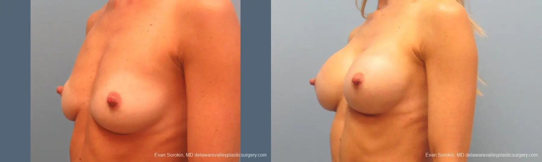 Philadelphia Breast Augmentation 9396 - Before and After 4