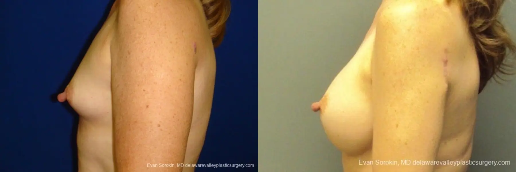 Philadelphia Breast Augmentation 8765 - Before and After 5