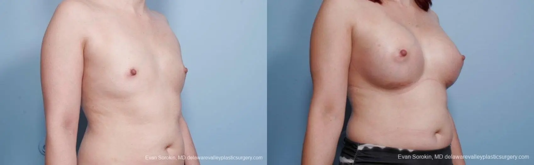 Breast Augmentation: Patient 55 - Before and After 2