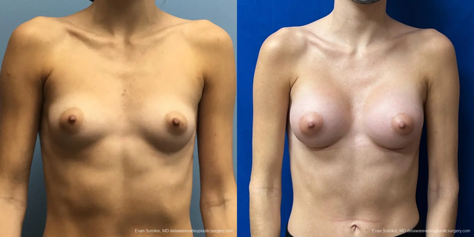 Breast Augmentation: Patient 226 - Before and After 1