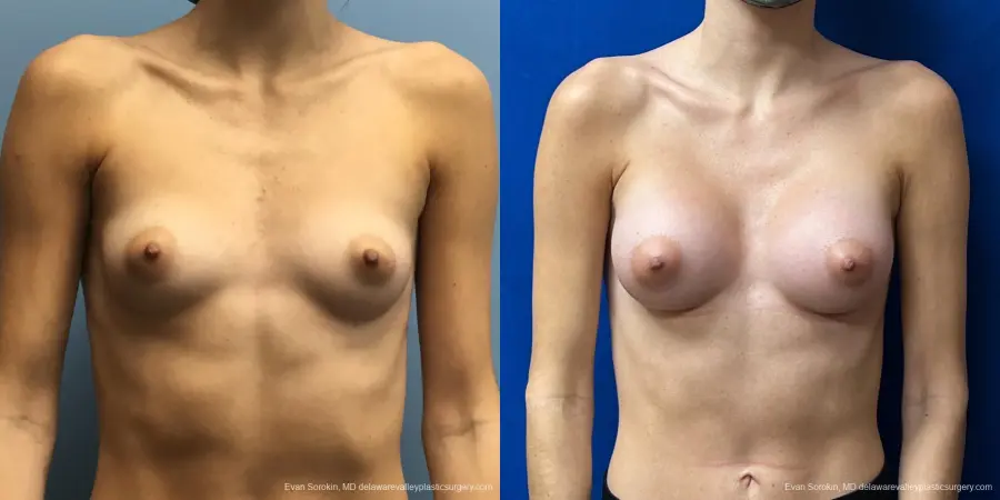Breast Augmentation: Patient 194 - Before and After 1