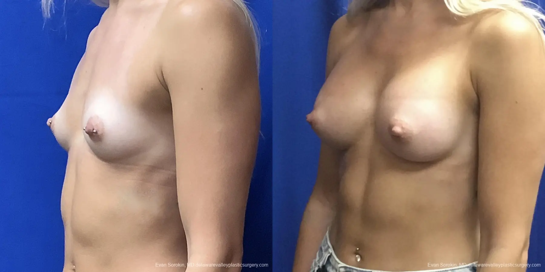 Breast Augmentation: Patient 165 - Before and After 3