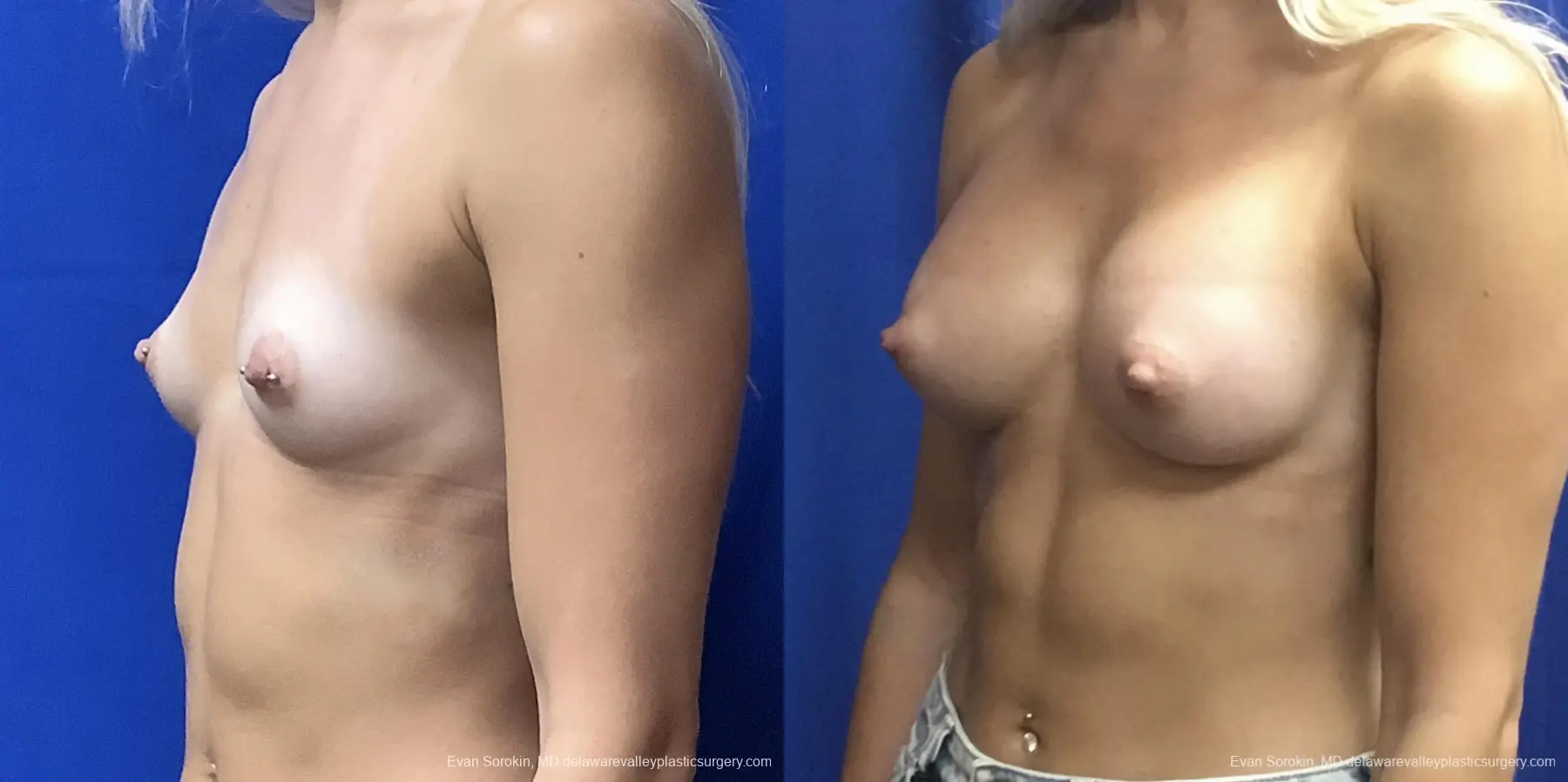Breast Augmentation: Patient 190 - Before and After 3