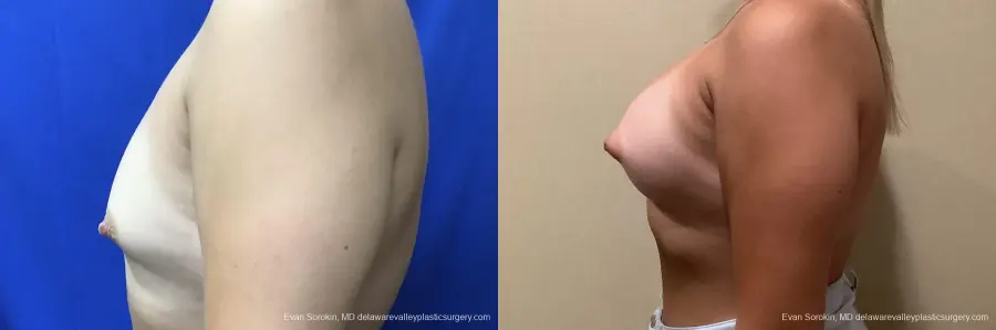 Breast Augmentation: Patient 172 - Before and After 5
