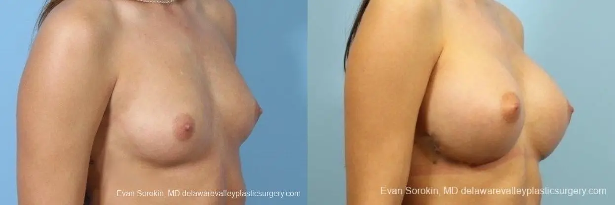 Philadelphia Breast Augmentation 8657 - Before and After 2
