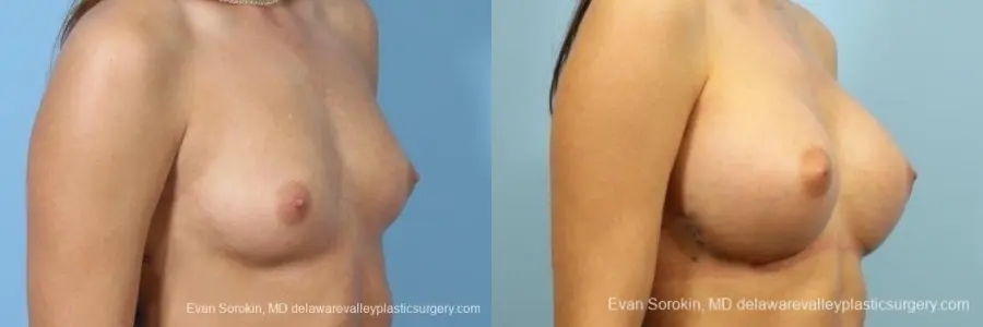 Philadelphia Breast Augmentation 8657 - Before and After 2