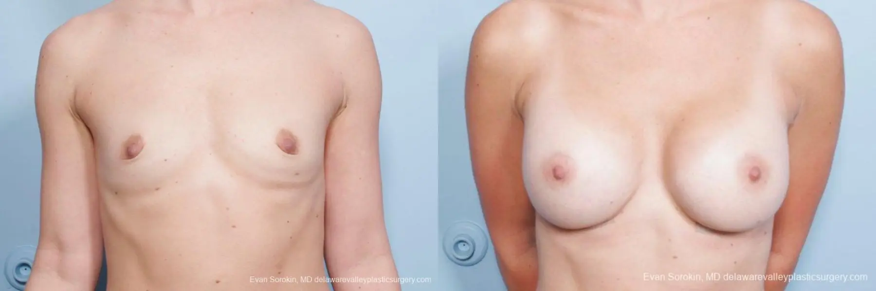 Philadelphia Breast Augmentation 8651 - Before and After 1