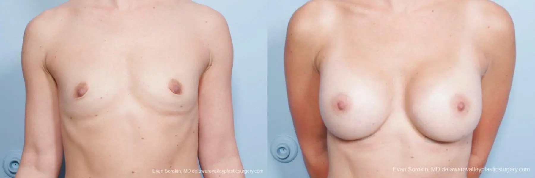 Philadelphia Breast Augmentation 8651 - Before and After