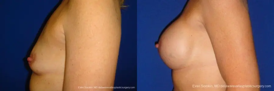 Philadelphia Breast Augmentation 9412 - Before and After 5