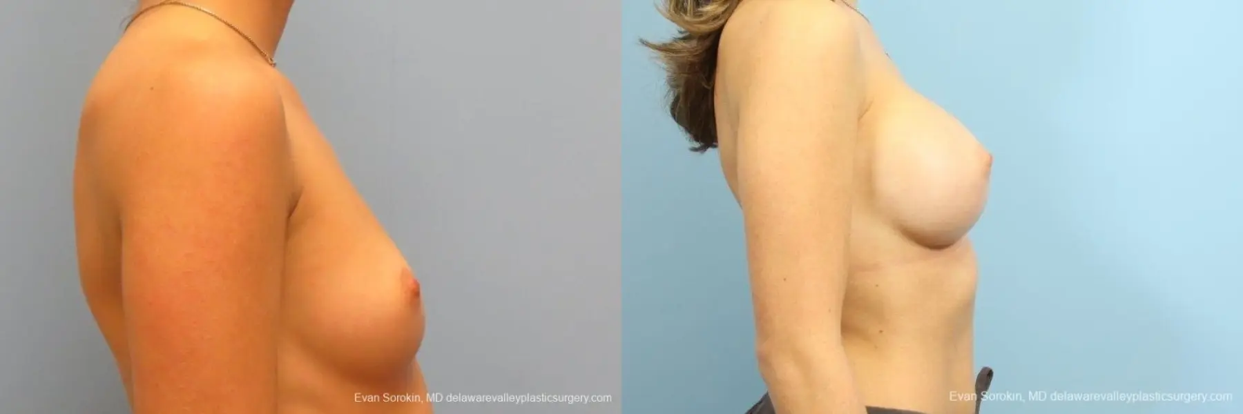 Philadelphia Breast Augmentation 8666 - Before and After 4