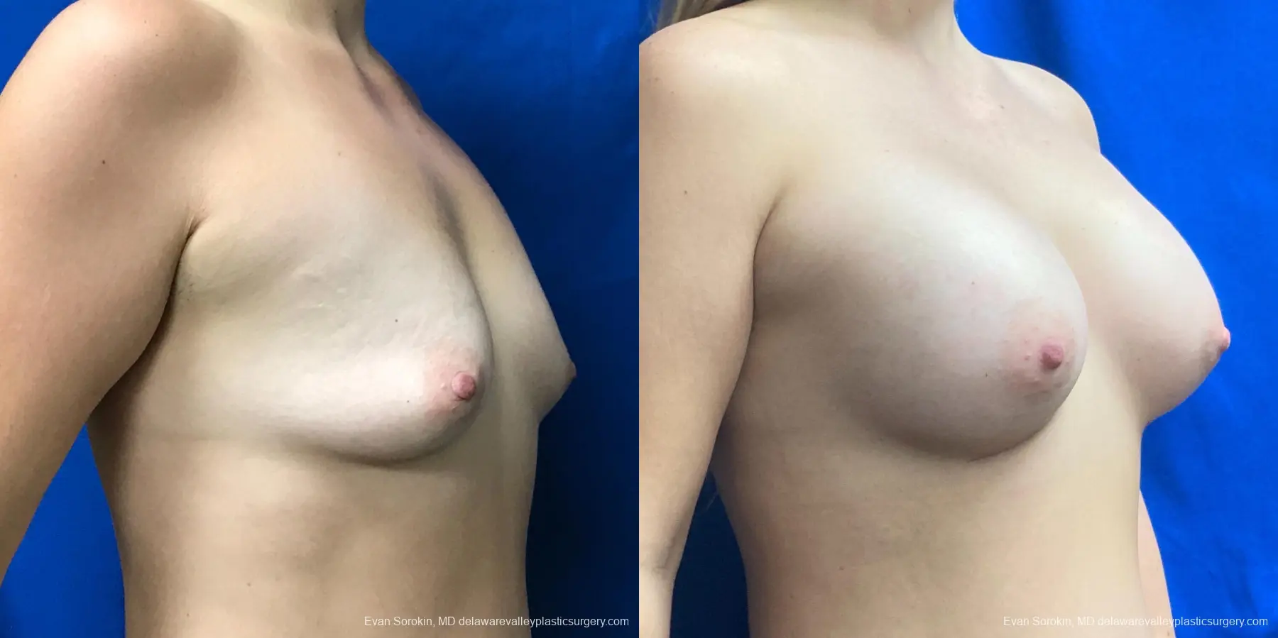 Breast Augmentation: Patient 190 - Before and After 2