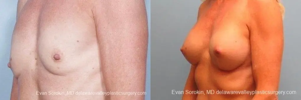 Philadelphia Breast Augmentation 8770 - Before and After 3