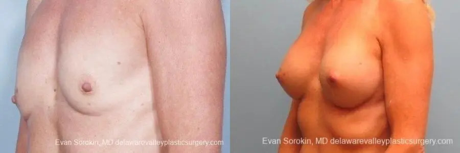Philadelphia Breast Augmentation 8770 - Before and After 3