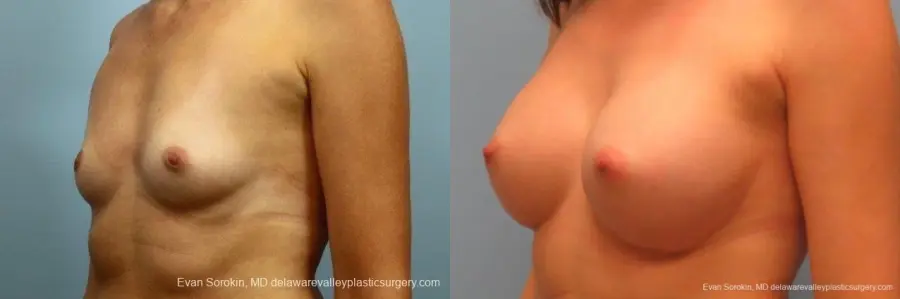 Philadelphia Breast Augmentation 8764 - Before and After 3