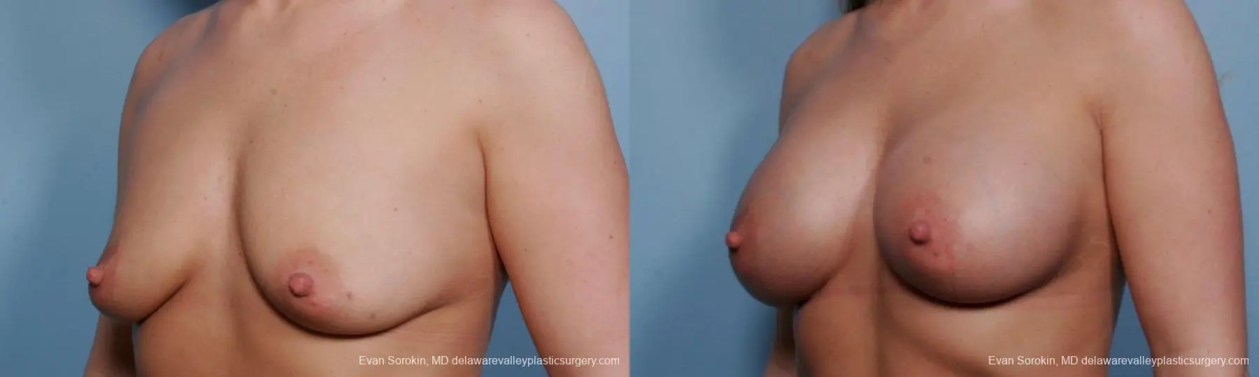 Philadelphia Breast Augmentation 9372 - Before and After 4