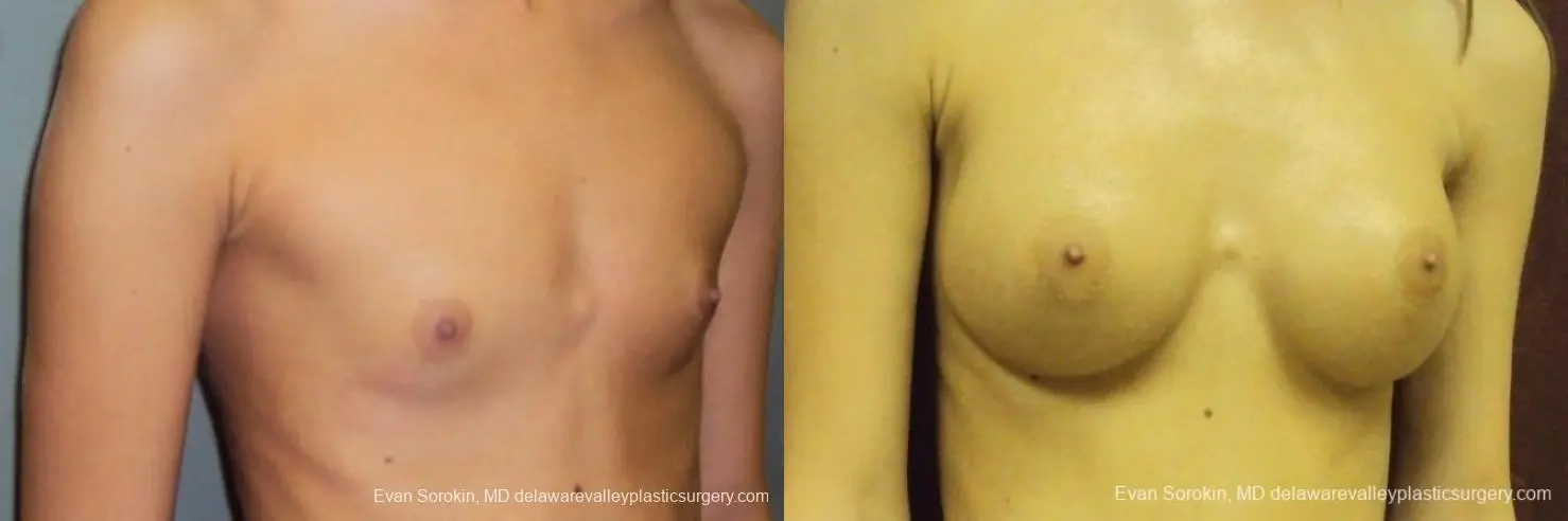 Philadelphia Breast Augmentation 8668 - Before and After 2