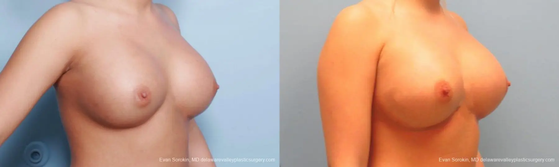 Philadelphia Breast Augmentation 9394 - Before and After 2