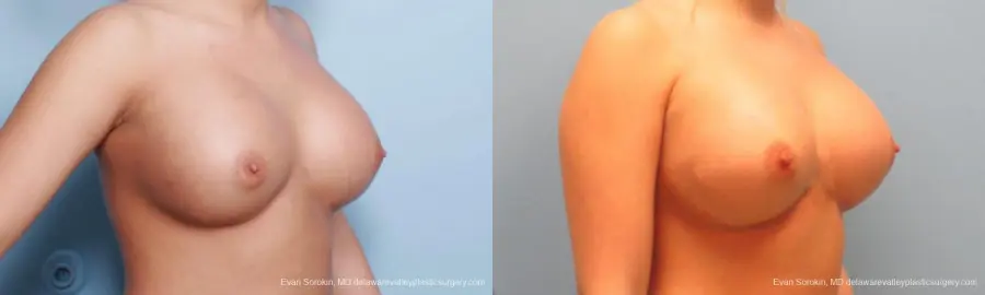 Philadelphia Breast Augmentation 9394 - Before and After 2