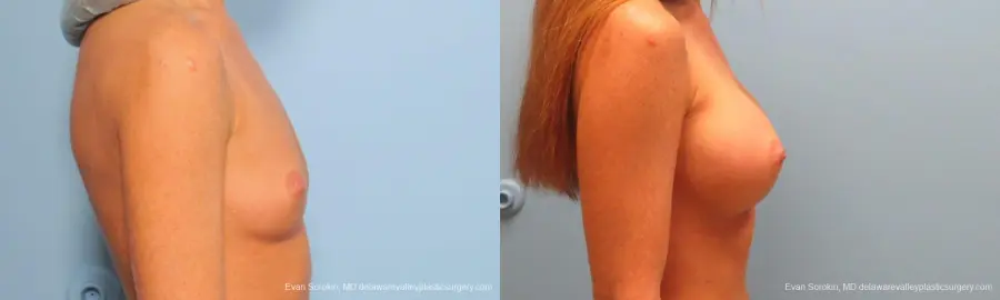 Philadelphia Breast Augmentation 9179 - Before and After 3