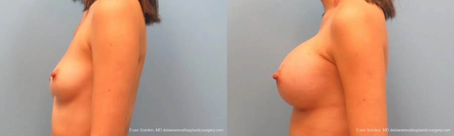 Philadelphia Breast Augmentation 9342 - Before and After 5