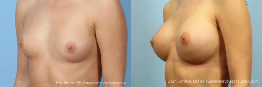 Philadelphia Breast Augmentation 8657 - Before and After 3
