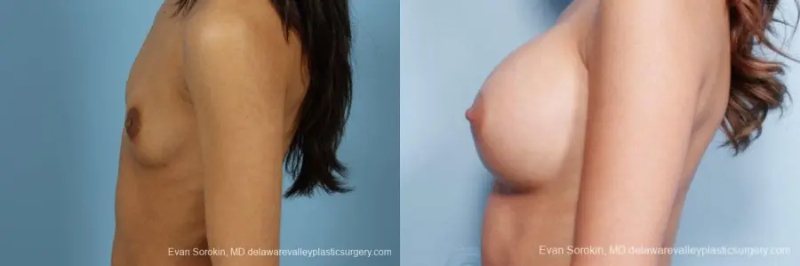 Philadelphia Breast Augmentation 9411 - Before and After 3