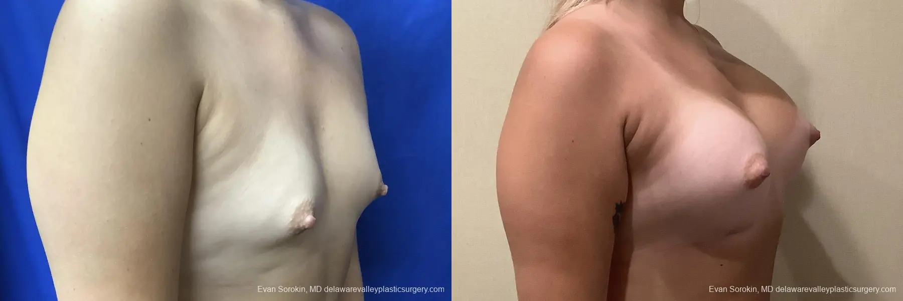 Breast Augmentation: Patient 198 - Before and After 2