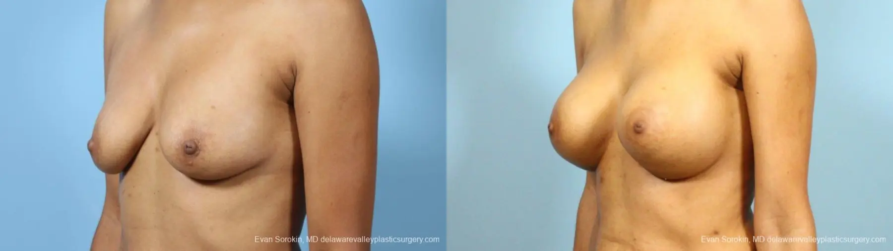 Philadelphia Breast Augmentation 9288 - Before and After 4