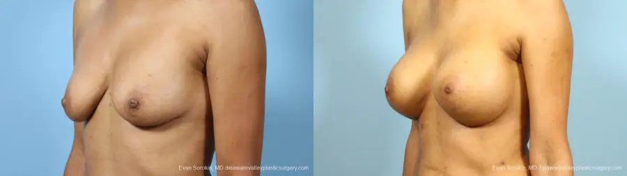 Philadelphia Breast Augmentation 9288 - Before and After 4