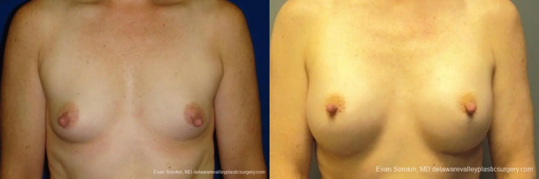 Philadelphia Breast Augmentation 8765 - Before and After 1