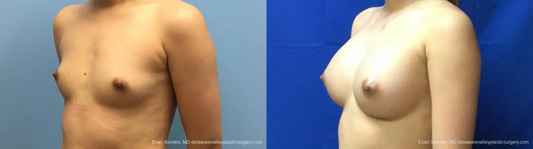 Philadelphia Breast Augmentation 13172 - Before and After 4