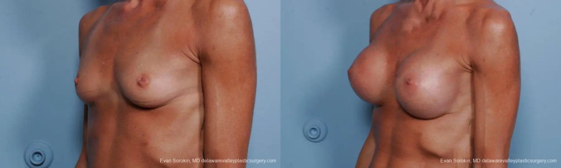 Philadelphia Breast Augmentation 8656 - Before and After 3