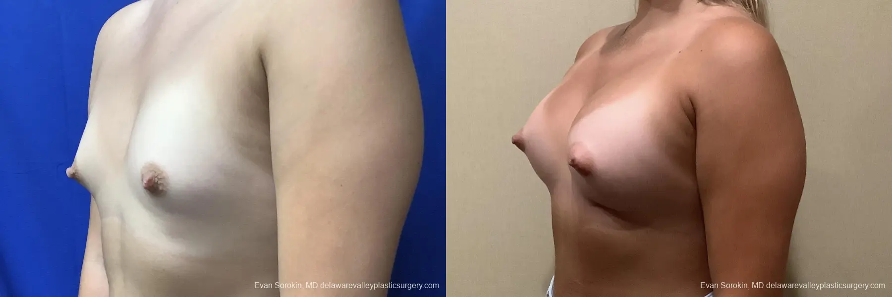 Breast Augmentation: Patient 172 - Before and After 4