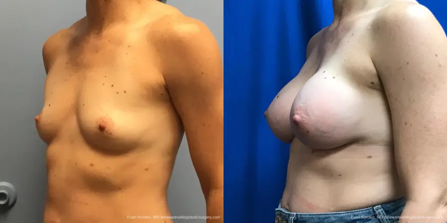 Breast Augmentation: Patient 183 - Before and After 4
